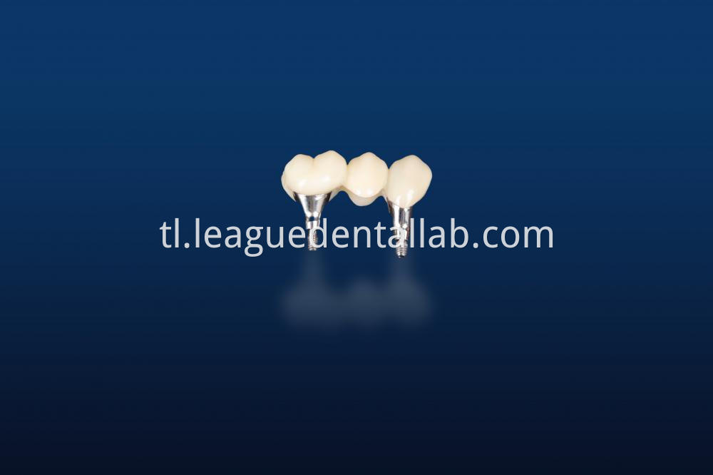 Dental Implant Crown, Dental Implant Zirconia crown,Dental Implant Emax crown,Dental Implant Bridge